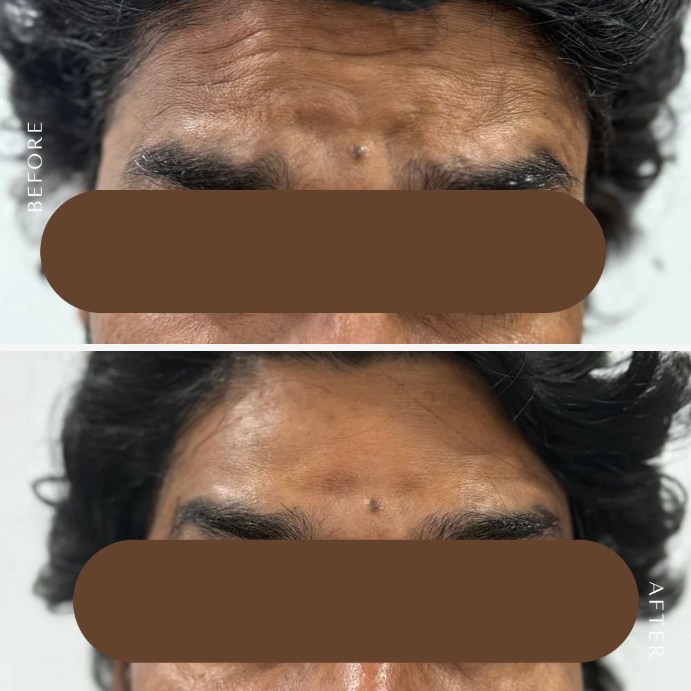 Lip Filler Treatment