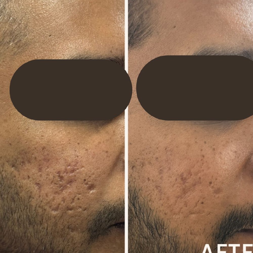 Chemical Peel Treatment